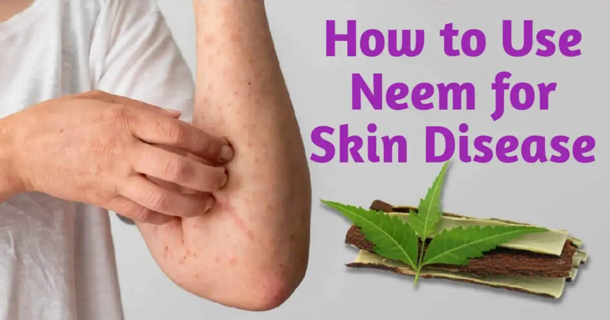 How to Use Neem for Skin Diseases: Expert Tips