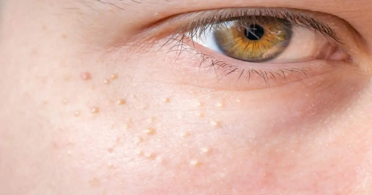 How to Get Rid of Milia: 5 Natural Home Treatments for Clear Skin
