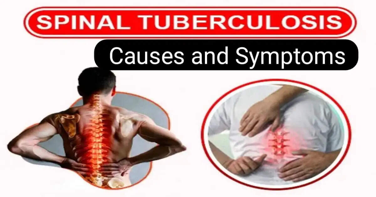 Understanding Spinal Tuberculosis: Symptoms and Treatment Explained