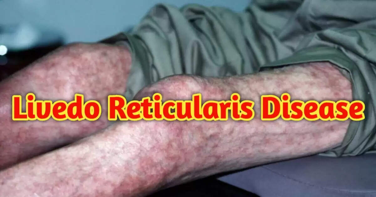What is Livedo Reticularis? Causes and Symptoms Explained