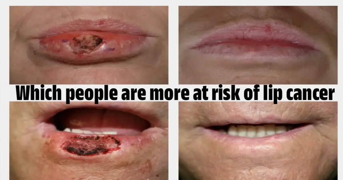 Who Is Most at Risk for Lip Cancer? Doctors Explain the Key Factors