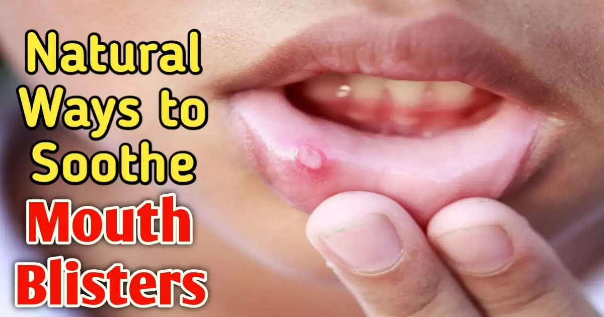 Top 5 Home Remedies for Mouth Blister Relief