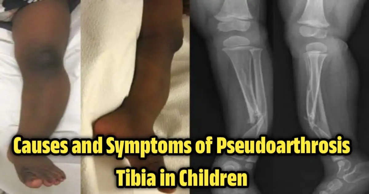 Causes and Symptoms of Pseudoarthrosis Tibia in Children